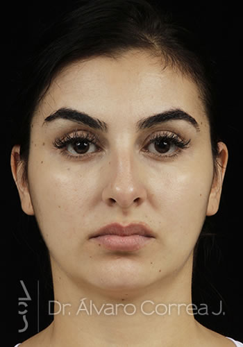 Rinoplastia Exceso de Dorso, Columela Colgante, Implante paranasal - Medellin, Colombia