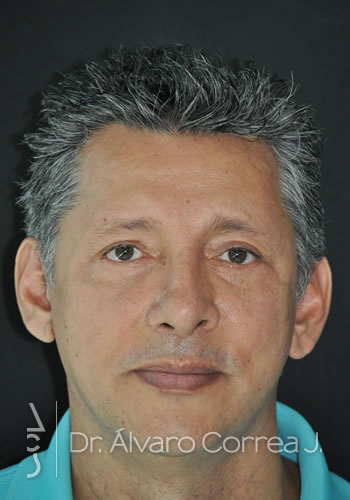 Blefaroplastia Superior e Inferior, Ritidoplastia, Ritidoplastia Tercio Medio - Medellin, Colombia