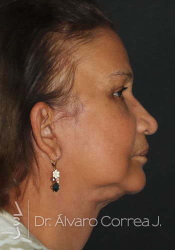 Cervicoplastia, Ritidoplastia, Ritidoplastia Tercio Medio - Medellin, Colombia