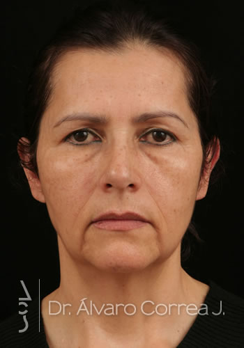 Mentoplastia, Implante paranasal, Blefaroplastia Superior, Ritidoplastia - Medellin, Colombia