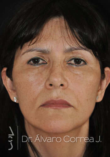 Mentoplastia, Implante paranasal, Blefaroplastia Superior, Ritidoplastia - Medellin, Colombia