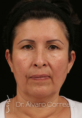 Implante paranasal, Blefaroplastia Superior, Cervicoplastia, Ritidoplastia - Medellin, Colombia