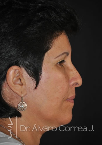 Implante paranasal, Blefaroplastia Superior, Cervicoplastia, Ritidoplastia - Medellin, Colombia