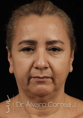 Blefaroplastia Superior e Inferior - Medellin, Colombia