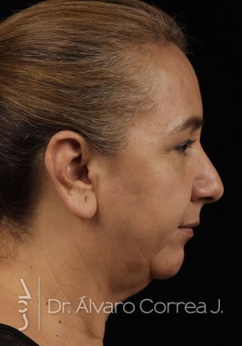 Blefaroplastia Superior e Inferior - Medellin, Colombia