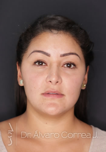 Rinoplastia Punta Ancha, Desviación Nasal - Medellin, Colombia