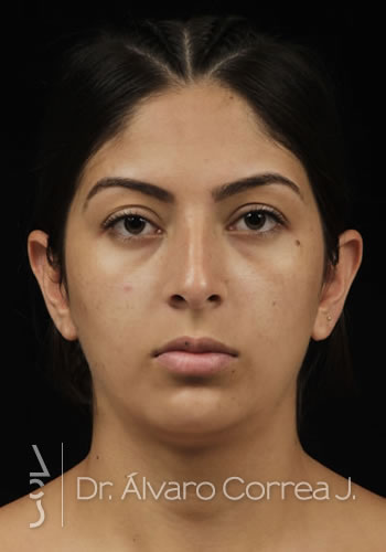 Rinoplastia Exceso de Dorso, Desviación Nasal - Medellin, Colombia