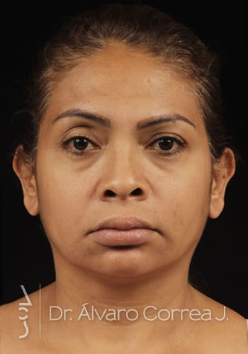 Rinoplastia Columela Retraida - Medellin, Colombia