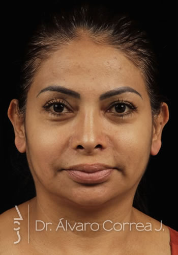 Rinoplastia Columela Retraida - Medellin, Colombia