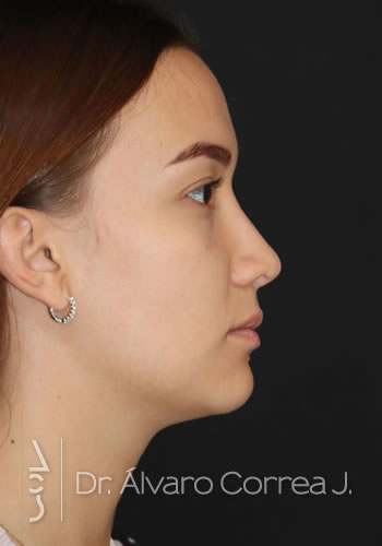 Rinoplastia Punta Ancha, Columela Retraida - Medellin, Colombia