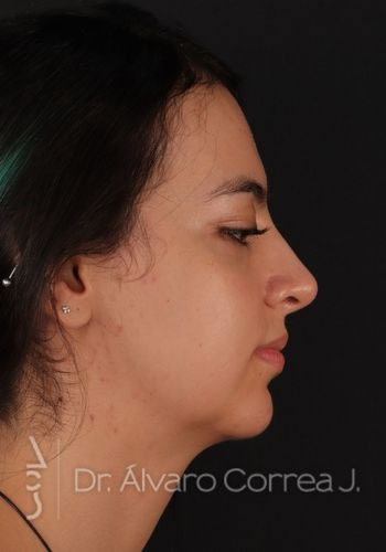 Rinoplastia Punta Caida, Exceso de Dorso, Base Nasal Ancha, Implante paranasal - Medellin, Colombia