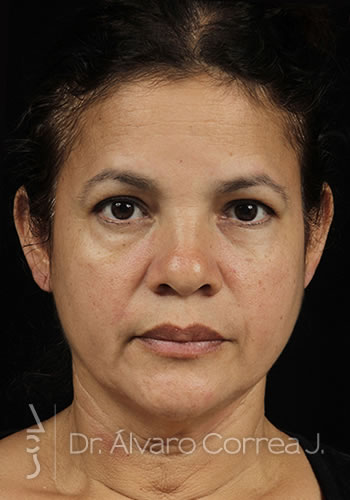 Punta Caida, Punta Ancha, Exceso de Dorso, Columela Retraida, Implante paranasal, Implante premaxilar, Blefaroplastia Superior e Inferior - Medellin, Colombia