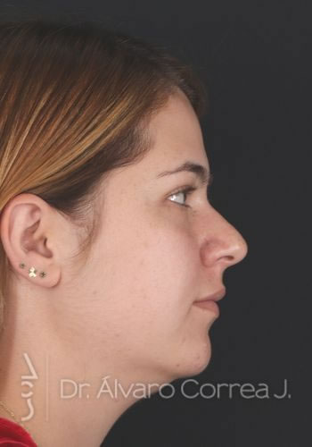 Rinoplastia Punta Ancha, Exceso de Dorso, Base Nasal Ancha - Medellin, Colombia