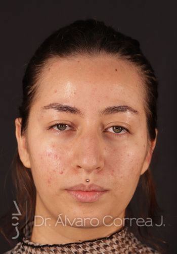 Rinoplastia Exceso de Dorso, Columela Colgante, Implante paranasal - Medellin, Colombia