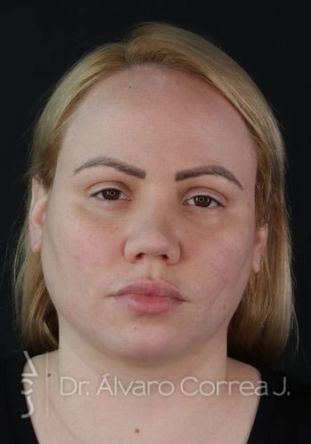 Rinoplastia Columela Retraida, Angulo Nasolabial, Angulo Nasofrontal, Secundaria - Medellin, Colombia