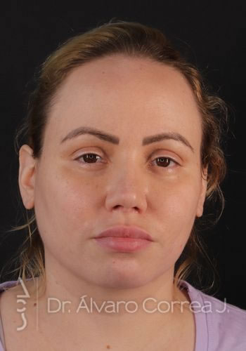 Rinoplastia Columela Retraida, Angulo Nasolabial, Angulo Nasofrontal, Secundaria - Medellin, Colombia